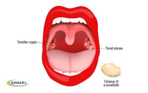 عفونت باکتریایی لوزه