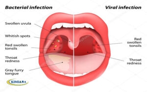 عفونت باکتریایی گلو