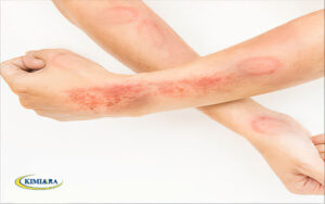 عفونتهای قارچی