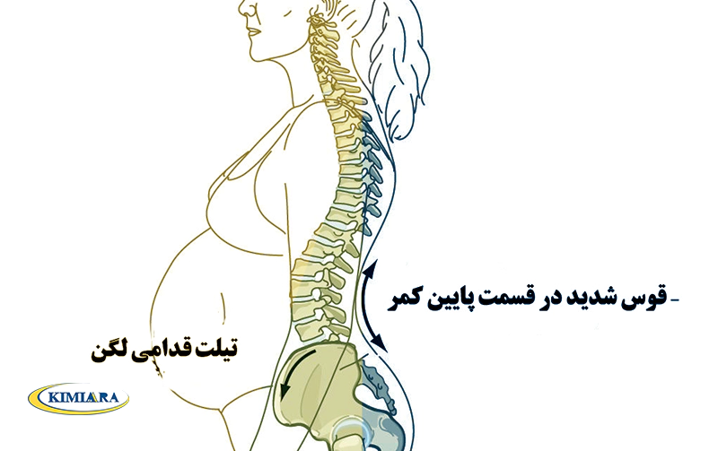 اضافه وزن و کمردرد 1 اضافه وزن و کمردرد