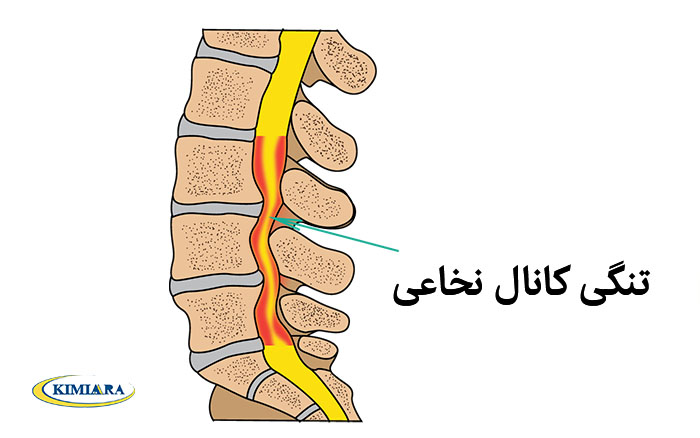تنگی کانال نخاعی