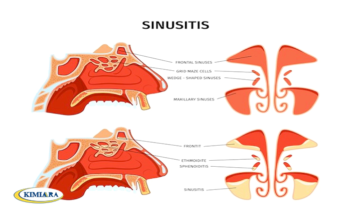 سینوزیت و مشکلات خواب: راهکارهایی برای بهبود خواب و استراحت شما 3 سینوزیت و مشکلات خواب: راهکارهایی برای بهبود خواب و استراحت شما