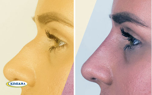 فیلر بینی چیست؟