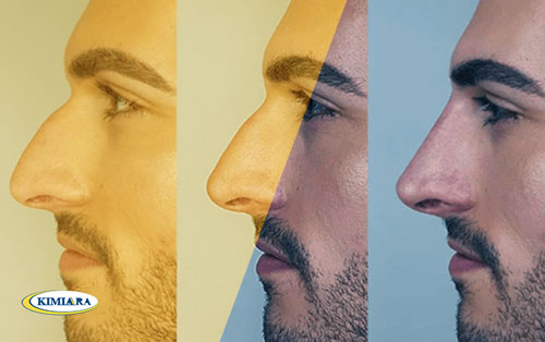 فیلر بینی چیست؟