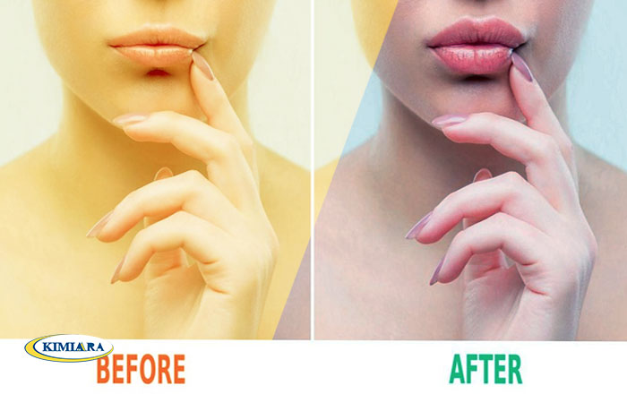 تکنیک تزریق ژل لب روسی چیست؟ 3 تکنیک تزریق ژل لب روسی چیست؟