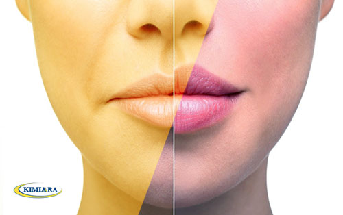 تکنیک تزریق ژل لب روسی چیست؟ 4 تکنیک تزریق ژل لب روسی چیست؟