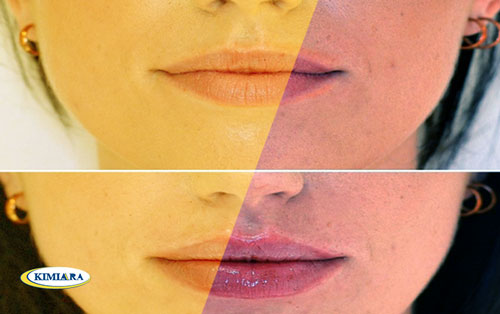 تکنیک تزریق ژل لب روسی چیست؟ 5 تکنیک تزریق ژل لب روسی چیست؟