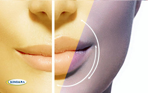 تکنیک تزریق ژل لب روسی چیست؟ 7 تکنیک تزریق ژل لب روسی چیست؟