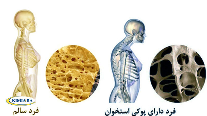 پیشگیری و درمان پوکی استخوان 4 پیشگیری و درمان پوکی استخوان