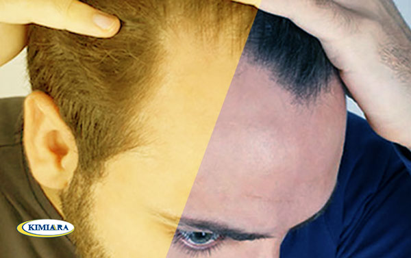 علت و درمان ریزش مو 3 علت و درمان ریزش مو