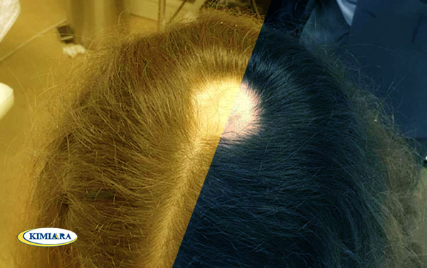 علت و درمان ریزش مو 6 علت و درمان ریزش مو