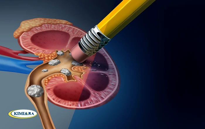 کلسیم و کاهش خطر ابتلا به سنگ کلیه