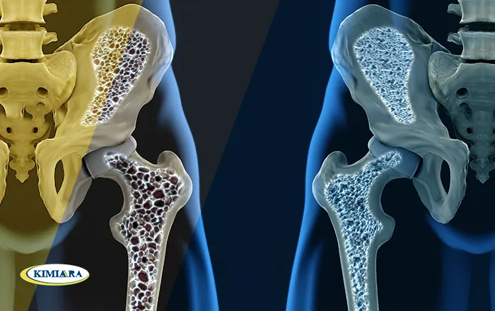 پیشگیری از اوستئوپروز پیشگیری از اوستئوپروز