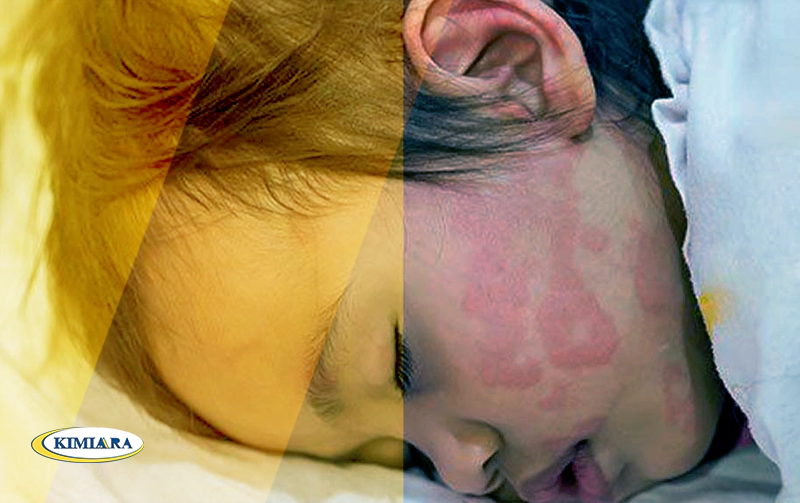 آیا آلرژی باعث تب در کودکان می شود؟ 4 تب و آلرژی در کودکان