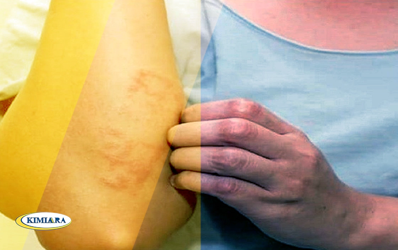 تفاوت آلرژی با سرماخوردگی چیست؟ 1 تفاوت آلرژی با سرماخوردگی