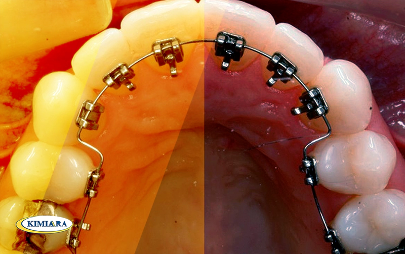 برای استحکام دندان چه کنیم؟ 4 استحکام دندان