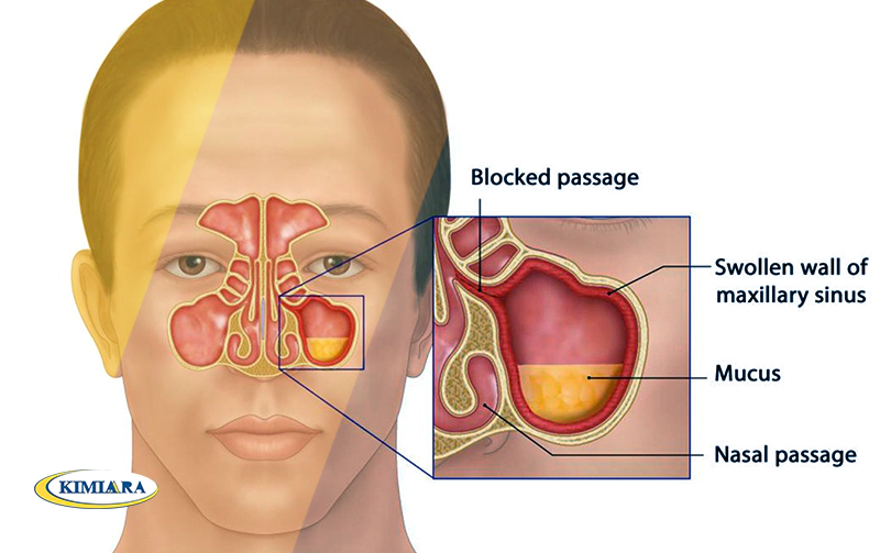 درمان رینوسینوزیت حاد با اسپری تسکین بینی و سینوس بتادین 1 رینوسینوزیت