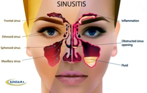 رینوسینوزیت