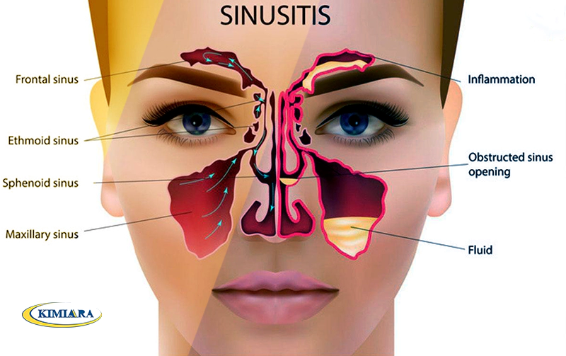 رینوسینوزیت