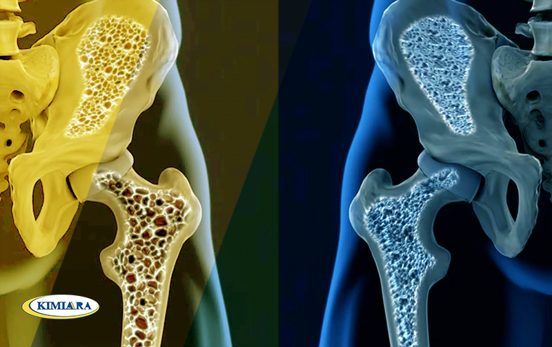 آیا پوکی استخوان قابل درمان است ؟ 2 آیا پوکی استخوان قابل درمان است