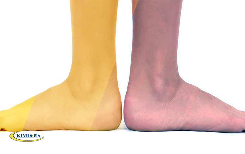 علت درد کف پا چیست و چه درمانی دارد؟ 1 علت درد کف پا