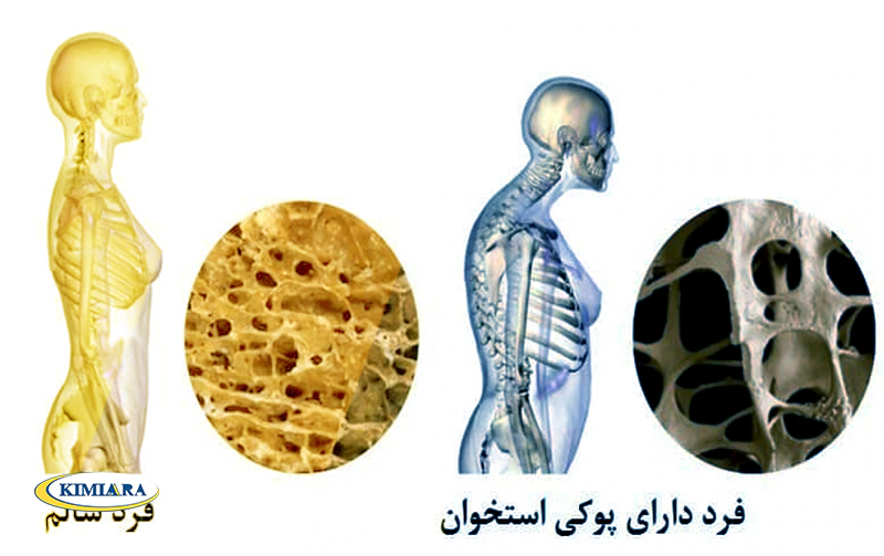 8 دلیل برای پوکی استخوان زودرس در زنان جوان 3 پوکی استخوان در زنان