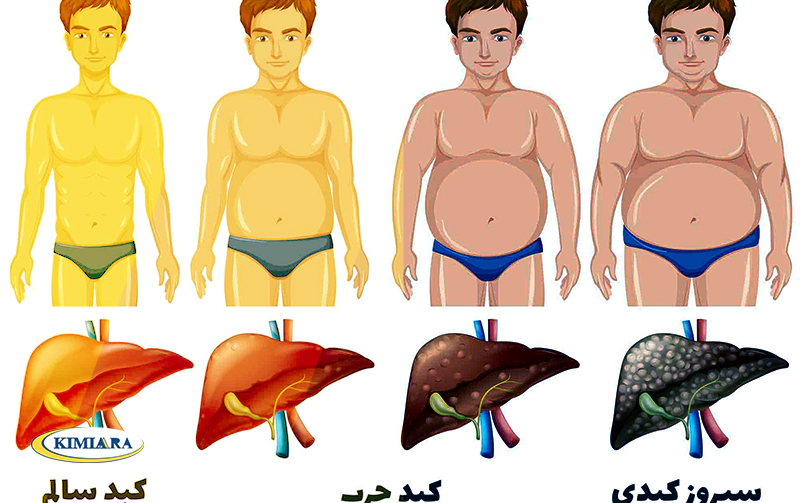 5 ویتامین و ماده معدنی مفید برای کبد چرب 1 کبد چرب