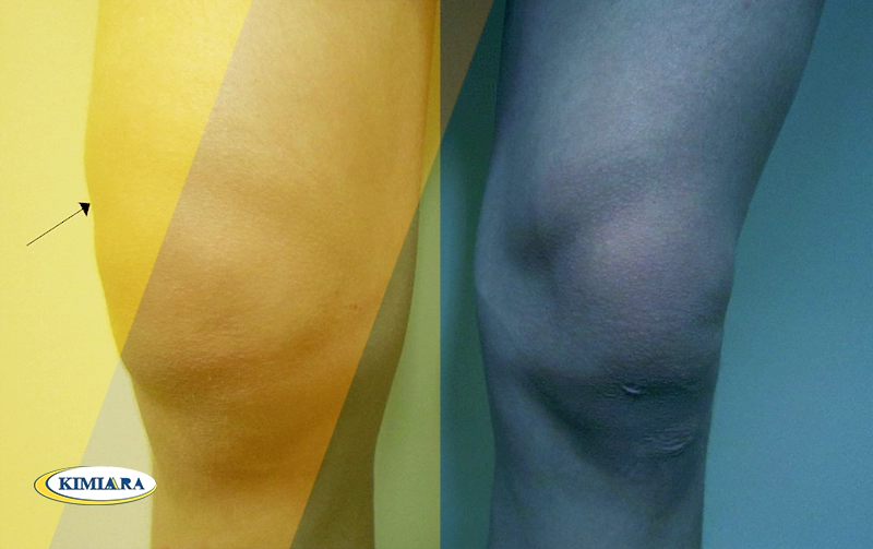 زانو درد؛ علل و راه های درمان فوری 2 زانو درد