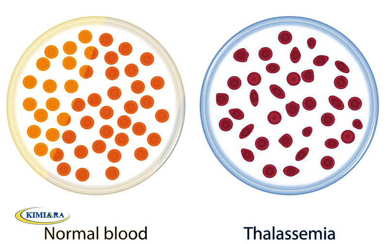 تفاوت کم خونی و تالاسمی چیست؟ 1 تفاوت کم خونی و تالاسمی