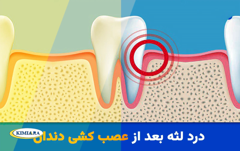راهکار سریع برای درمان درد دندان بعد از عصب کشی 2 درمان درد دندان بعد از عصب کشی