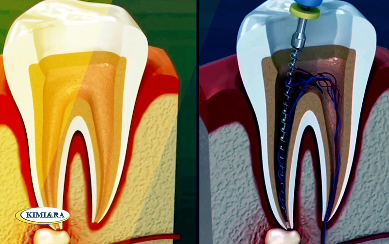 راهکار سریع برای درمان درد دندان بعد از عصب کشی 1 درمان درد دندان بعد از عصب کشی